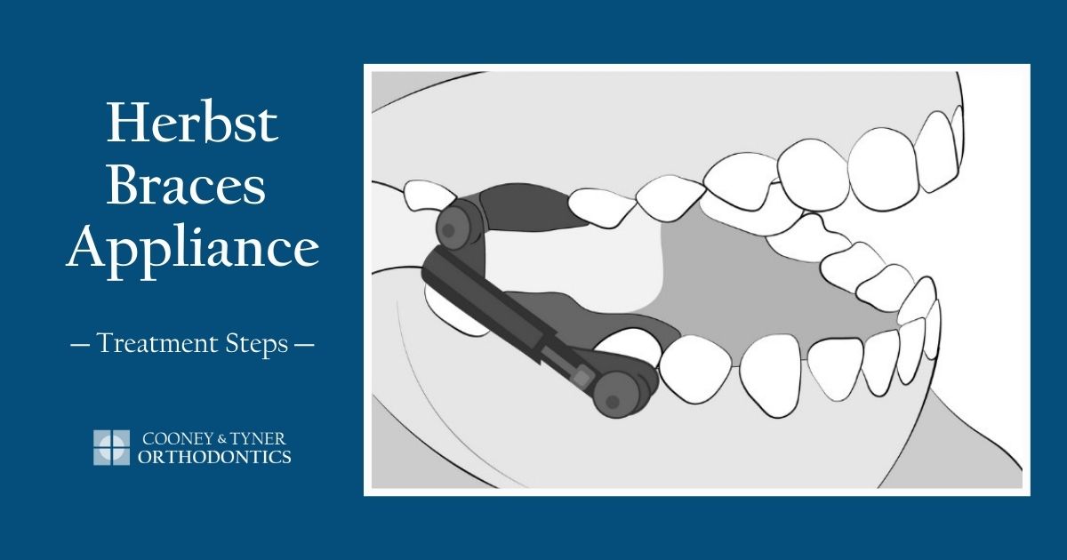 Herbst Braces Appliance Treatment Steps