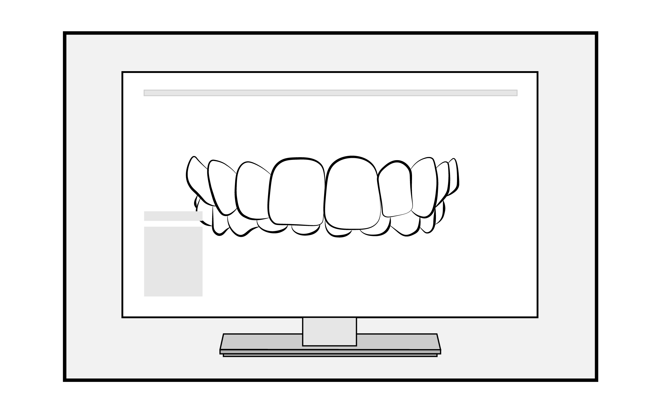Class 3 Carriere Invisalign Treatment Steps