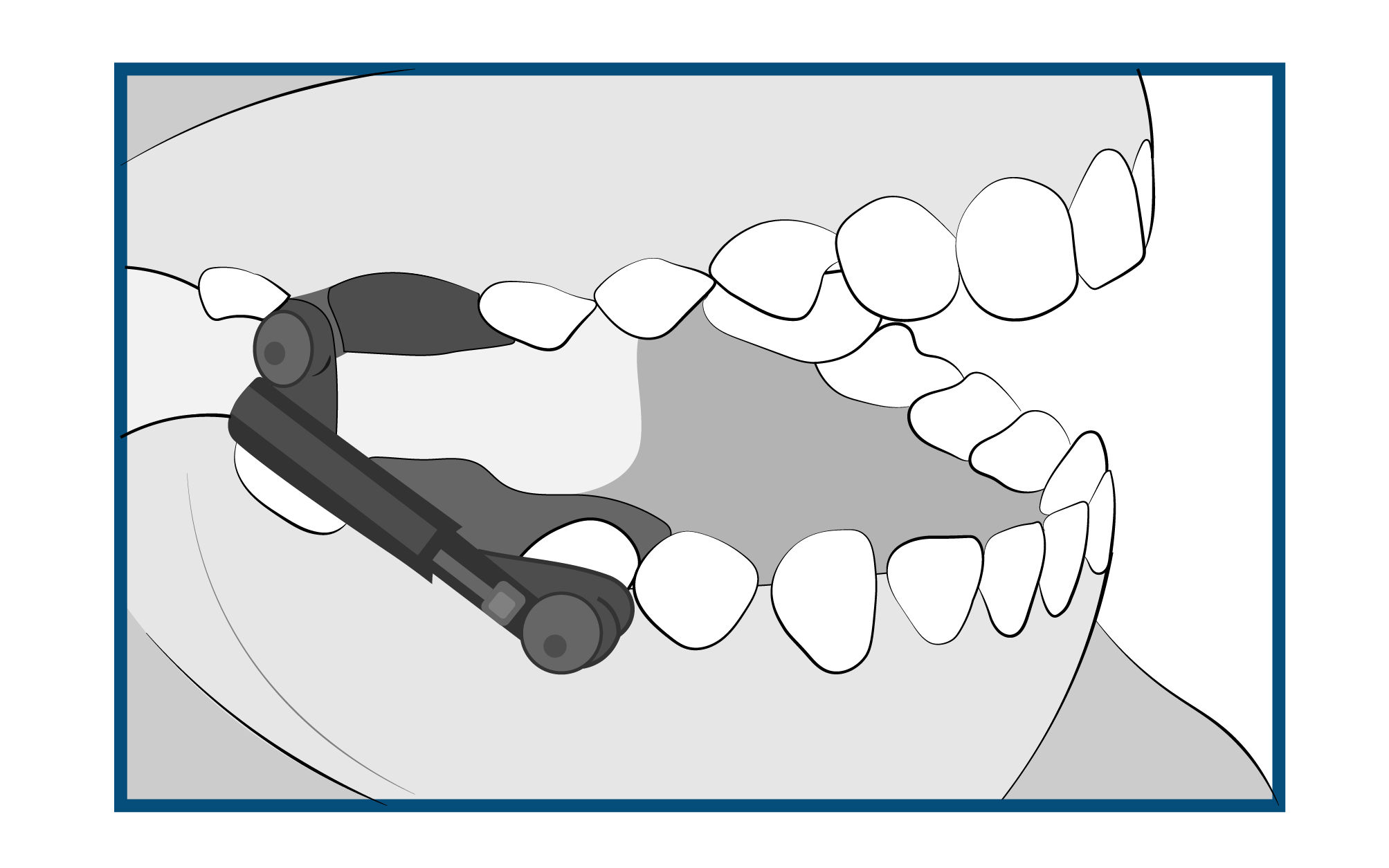 Herbst Braces Treatment Steps Cooney & Tyner Orthodontics