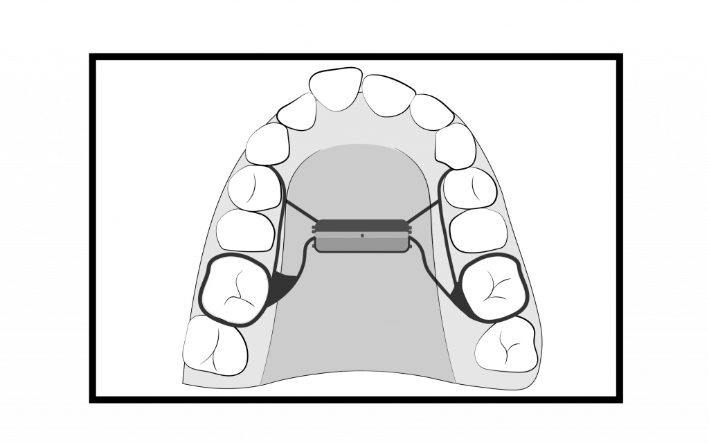RPE Braces Treatment Steps Cooney Orthodontics