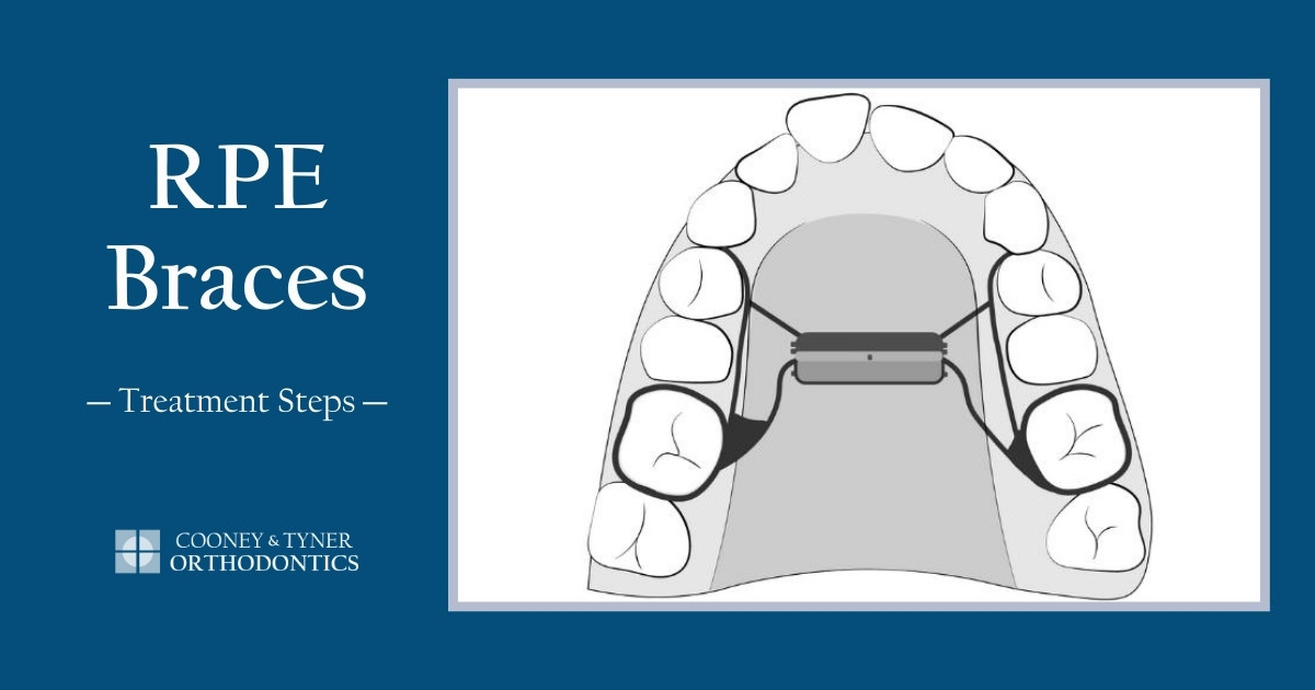 RPE Braces Treatment Steps