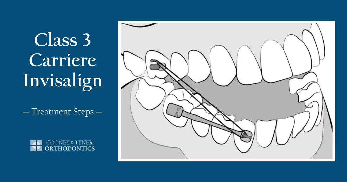 Class 3 Carriere Invisalign Treatment Steps