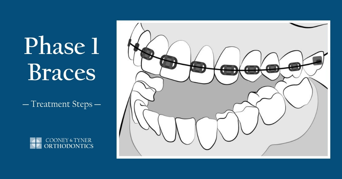 Phase 1 Braces Treatment Steps