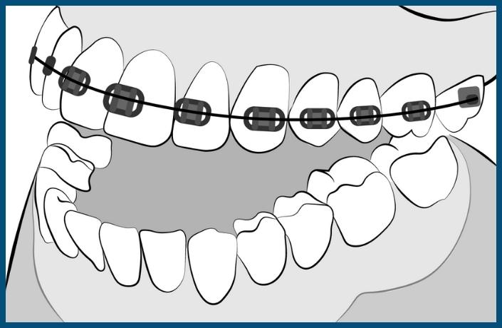 Placement of Top Braces