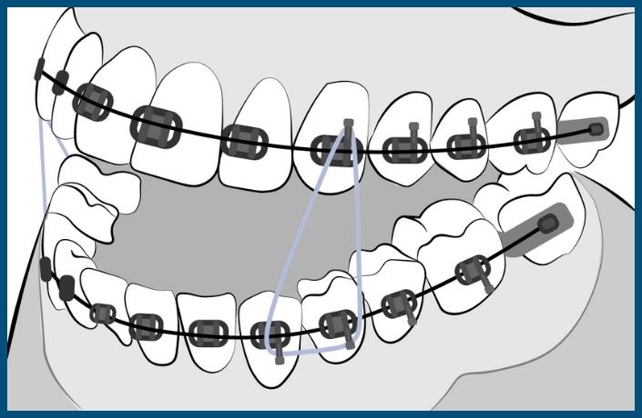 Placement of Braces
