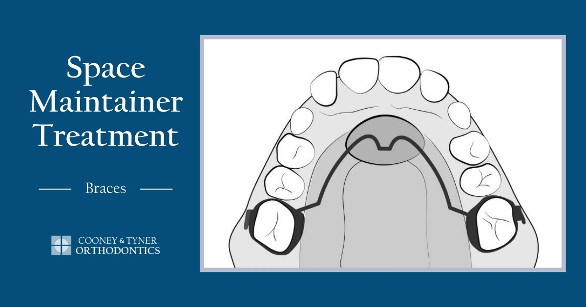 Space Maintainer Treatment Steps for Patients with Braces