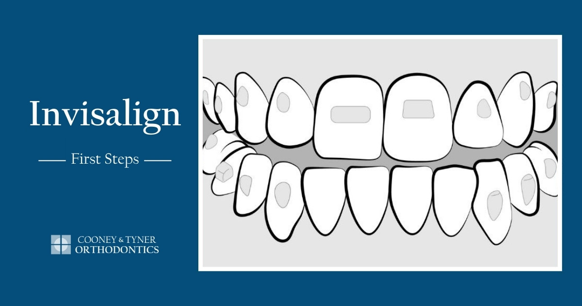 Invisalign Treatment - First Steps - Cooney & Tyner Orthodontics