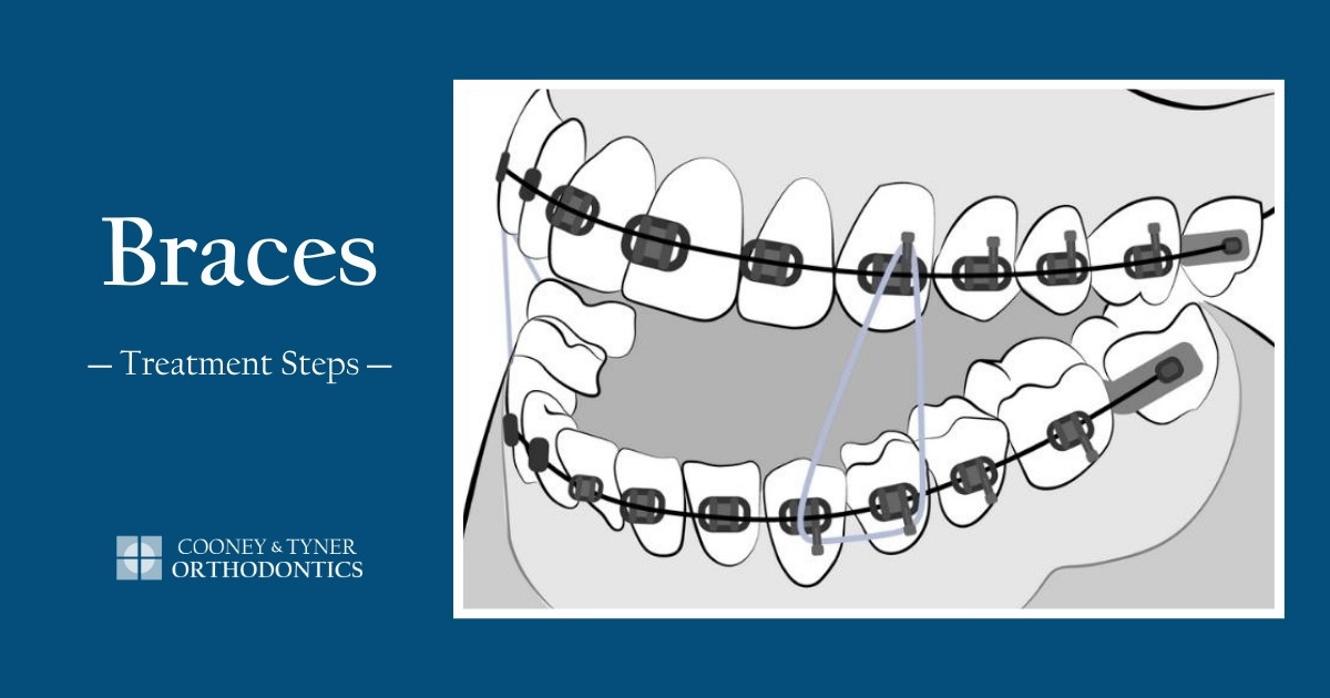 Braces Treatment Steps