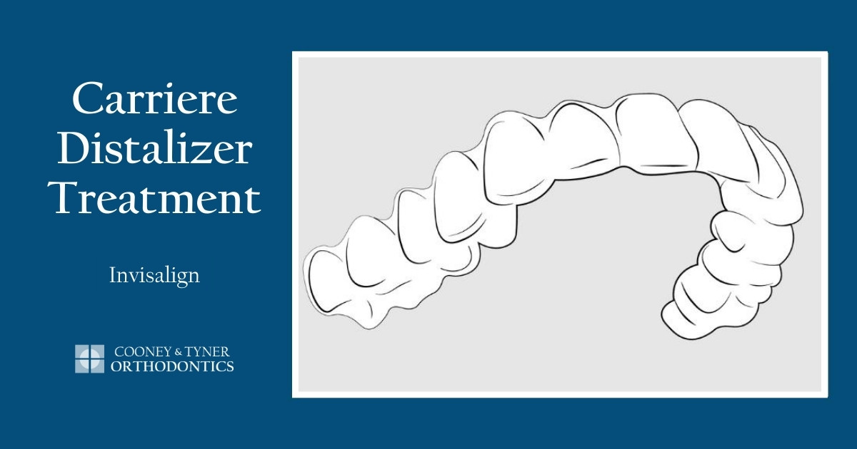 Carriere Distalizer Treatment Steps for Invisalign Patients