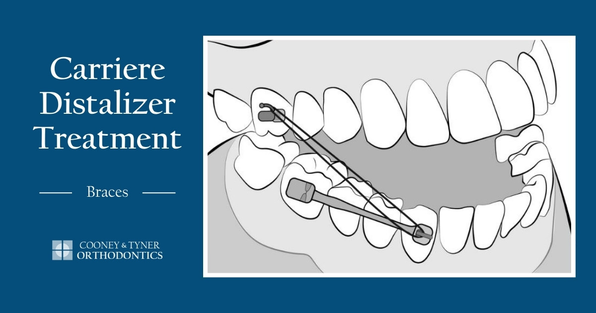 Carriere Distalizer Treatment Steps For Patients With Braces