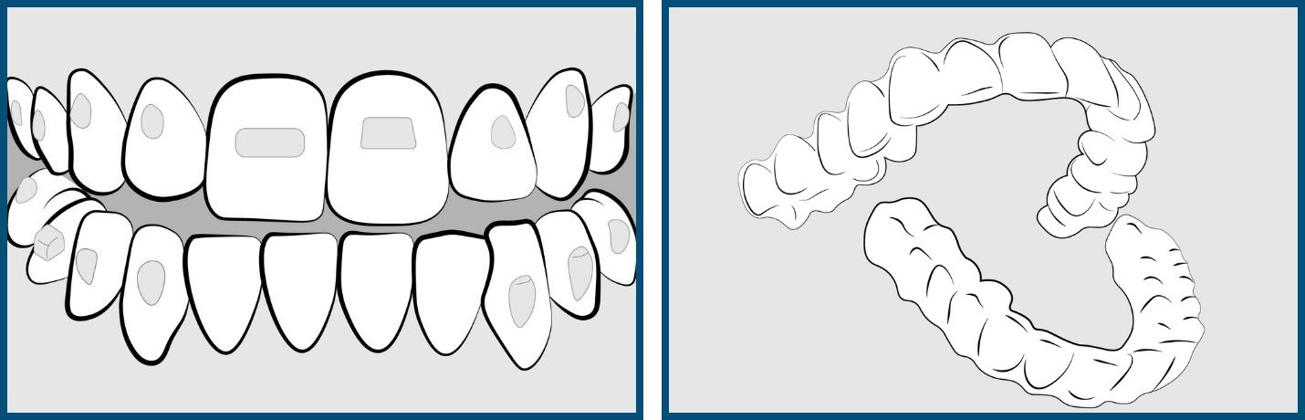 Placement of aattachments and delivery of Invisalign aligners