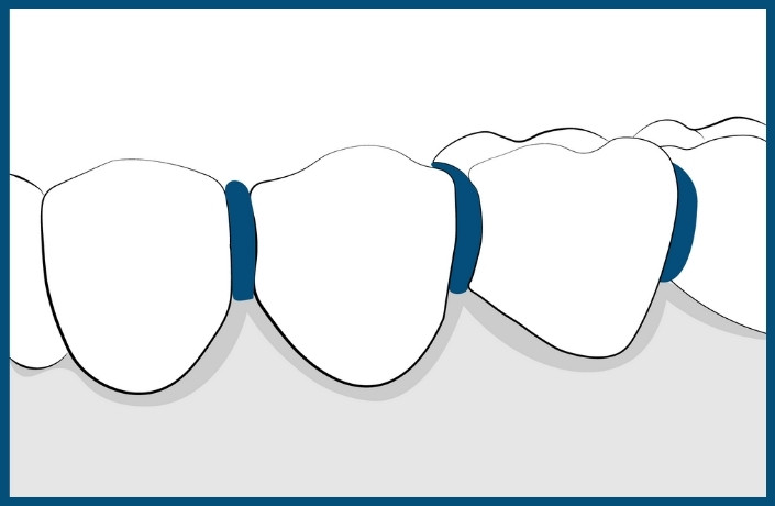 Orthodontic Treatment Step: Placing of Seperators