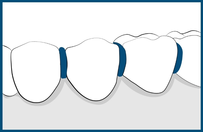Herbst Braces Treatment Step 2: Placement of Separators