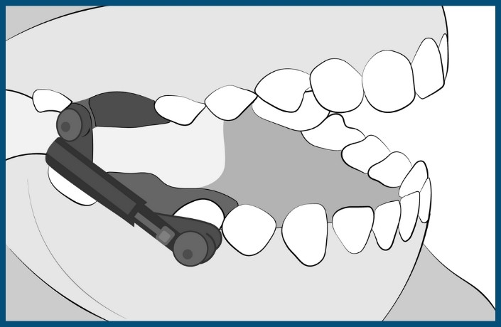 Herbst Braces Treatment Step 3: Placement of Herbst Appliance