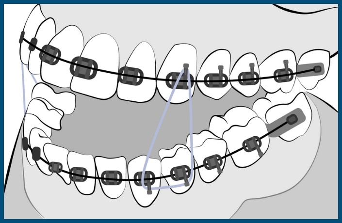Herbst Braces Treatment Step 4: Placement of Braces