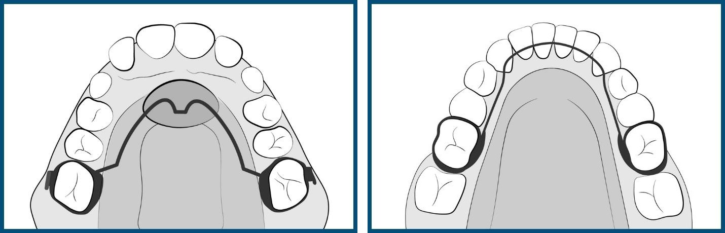 Placement of Space Maintainers