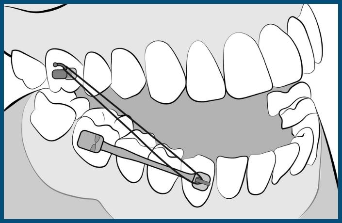 Placement of Carriere Distalizer appliances