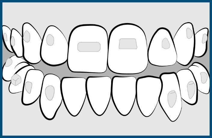 placement of lower Invisalign Aligners and attachments