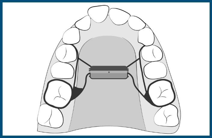 Orthodontic Treatment Step: Placement of Palate Expander