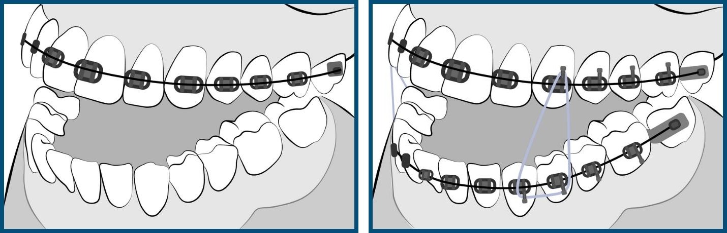 Placement of top and bottom braces